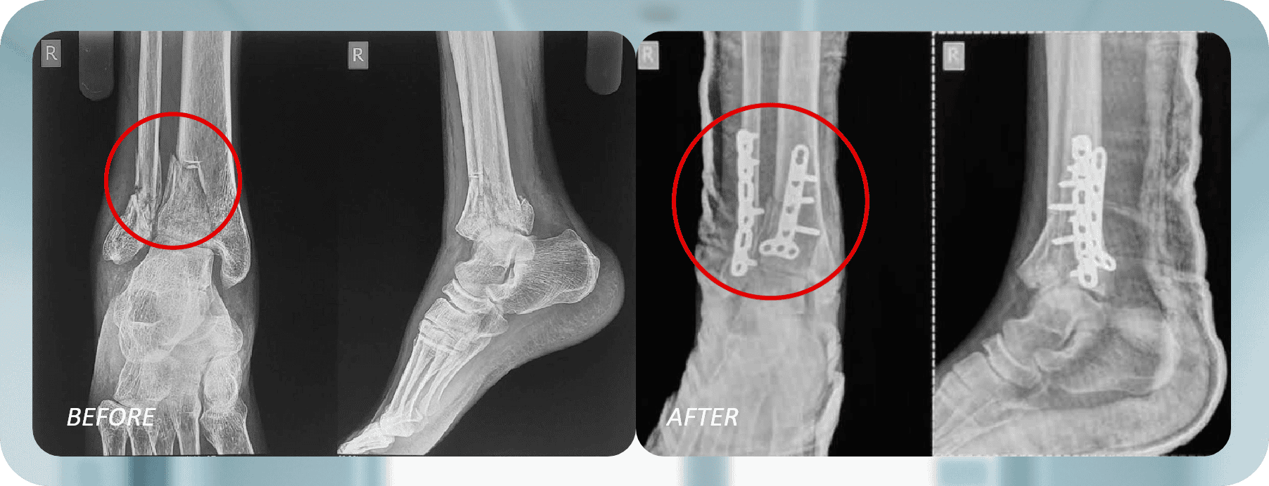 Ankle Surgery