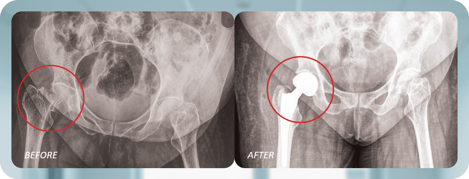 Hip Prosthesis