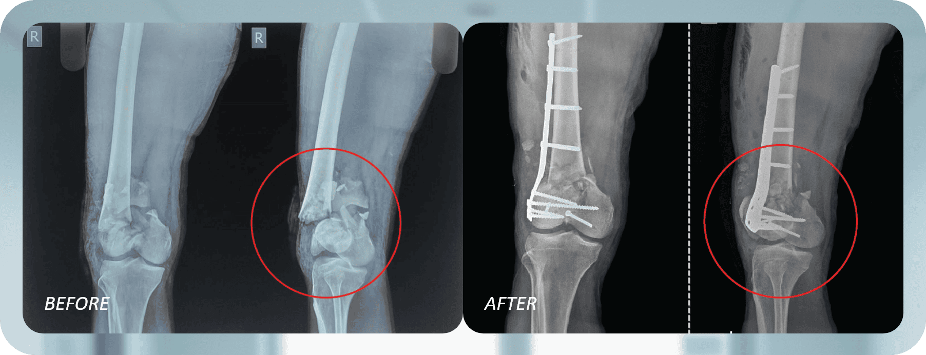 Open Distal Femur