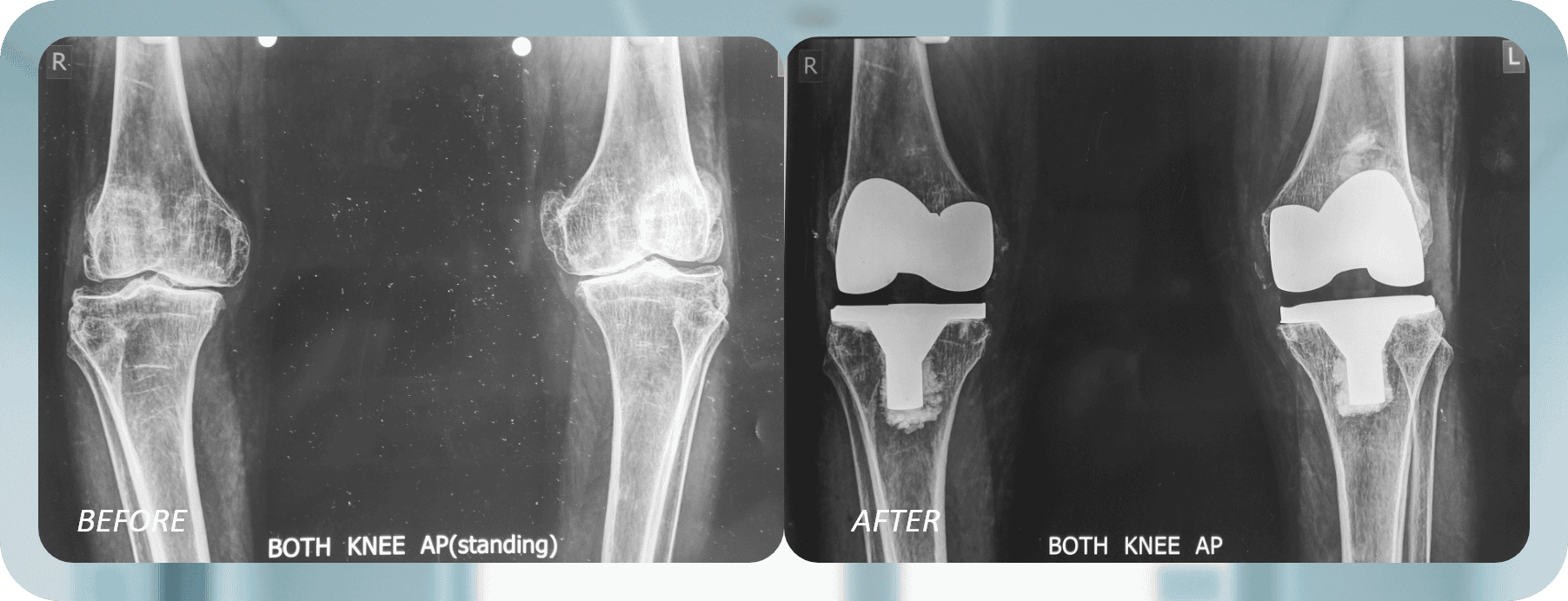 Total Knee Replacement